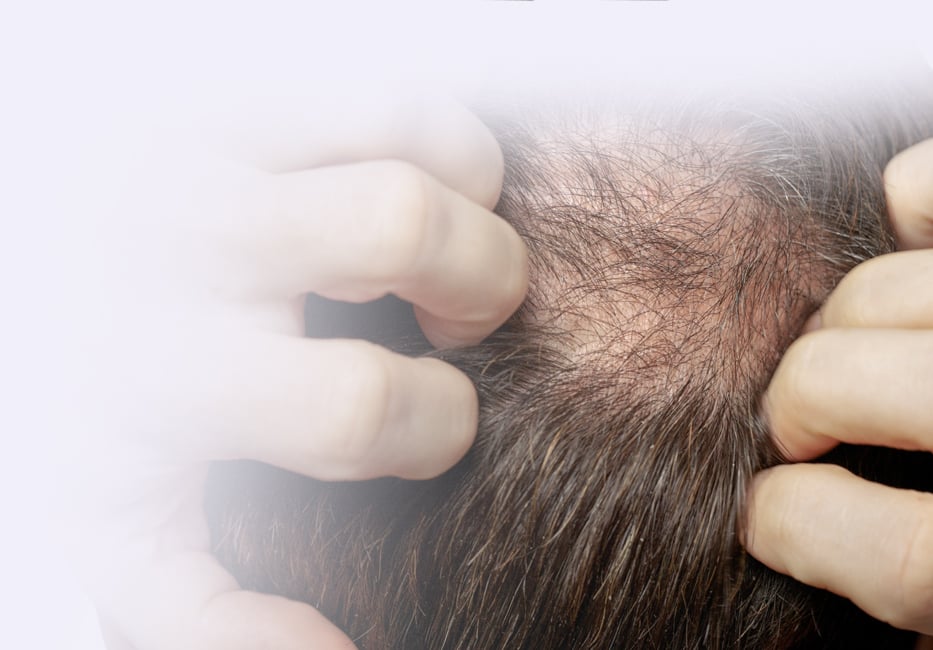 Hair Loss Treatment